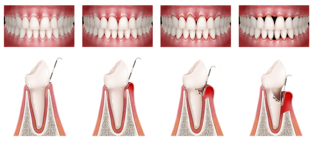 Periodontitis o ‘Piorrea’: ¿Qué Es? ¿Tiene Tratamiento?