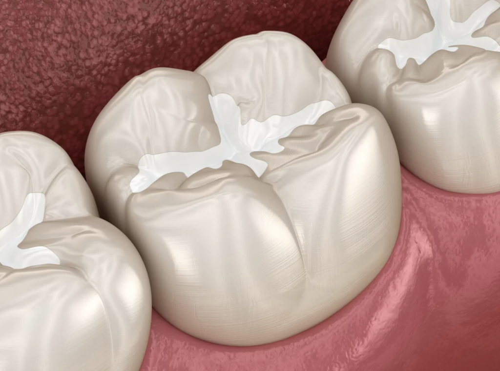 Descubre cómo los selladores dentales pueden proteger tus dientes y prevenir las caries