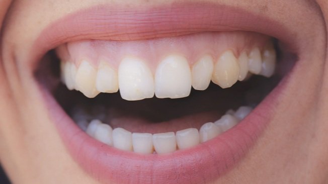 Sonrisa gingival: Cómo Corregirla y Hacerla Más Armónica