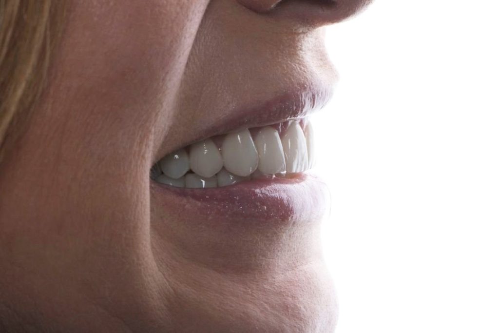 Carillas Dentales: El Tratamiento de Estética Dental más de Moda