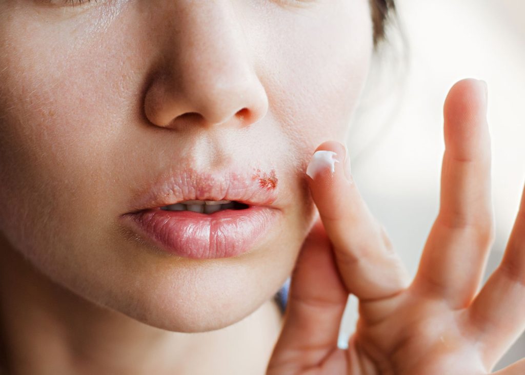 Herpes labial: cómo prevenir y tratar esta infección viral común