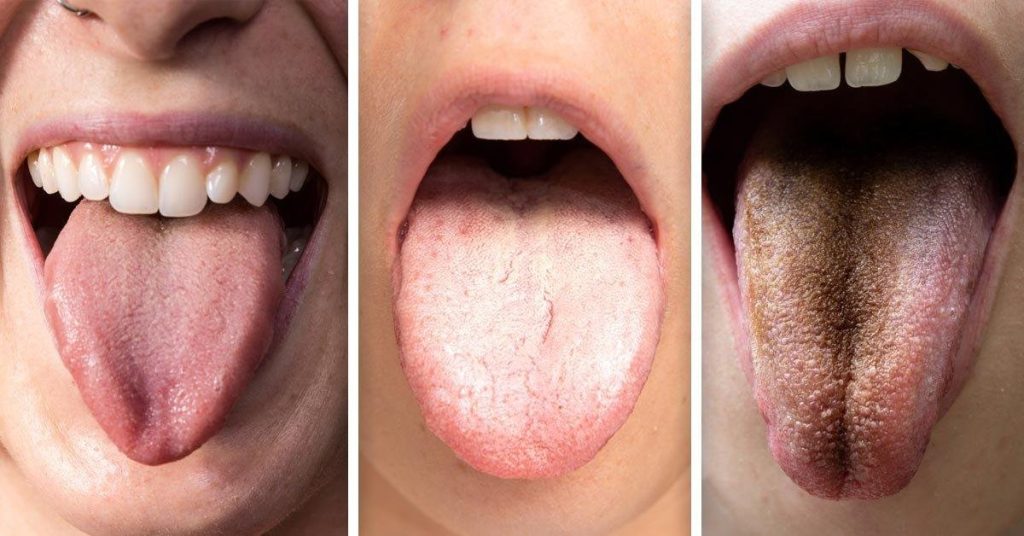 Blanca, Amarilla o Marrón: Esto Es Lo Que Significa El Color De Tu Lengua