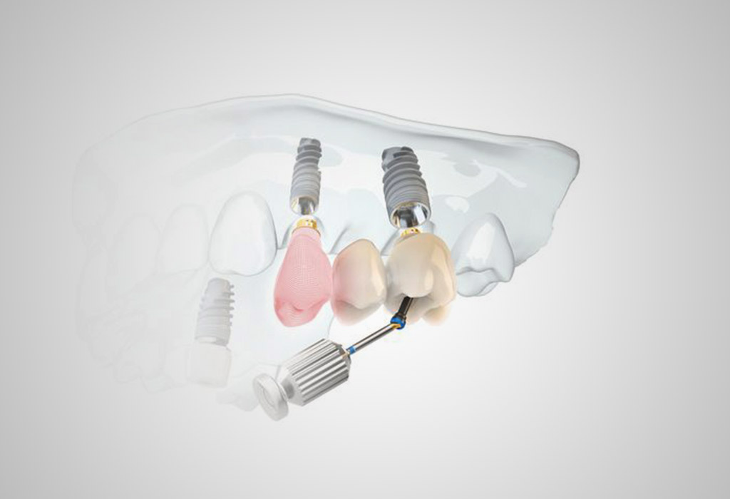 implantes dentales en Burgos