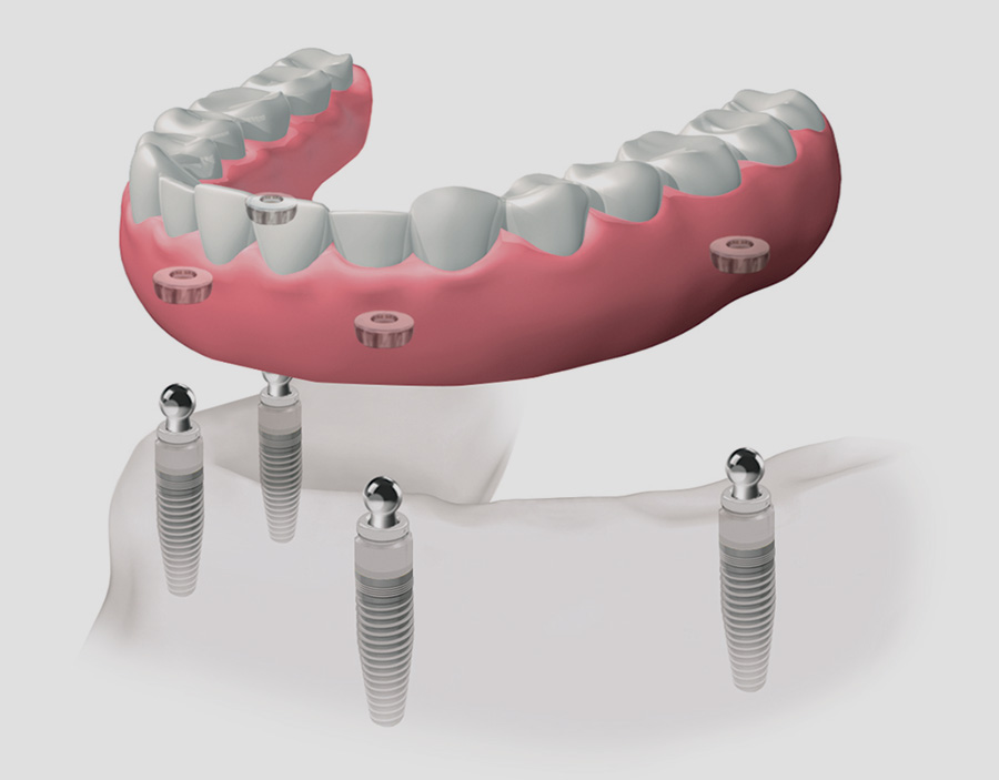 implantes dentales en Burgos