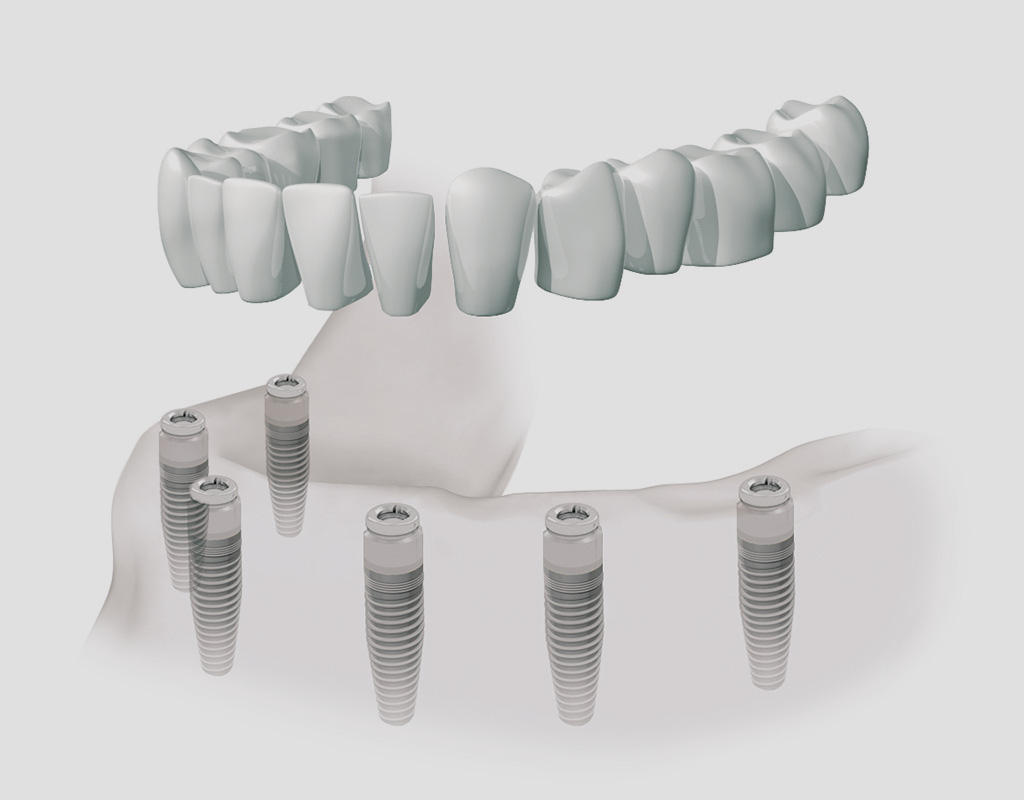 implantes dentales en Burgos