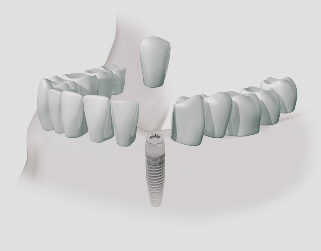 implantes dentales en Burgos