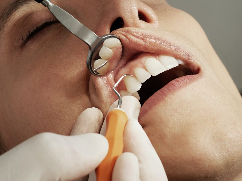 Todo lo que necesitas saber sobre las endodoncias: procedimiento, cuidados y recuperación